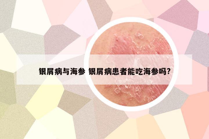 银屑病与海参 银屑病患者能吃海参吗?
