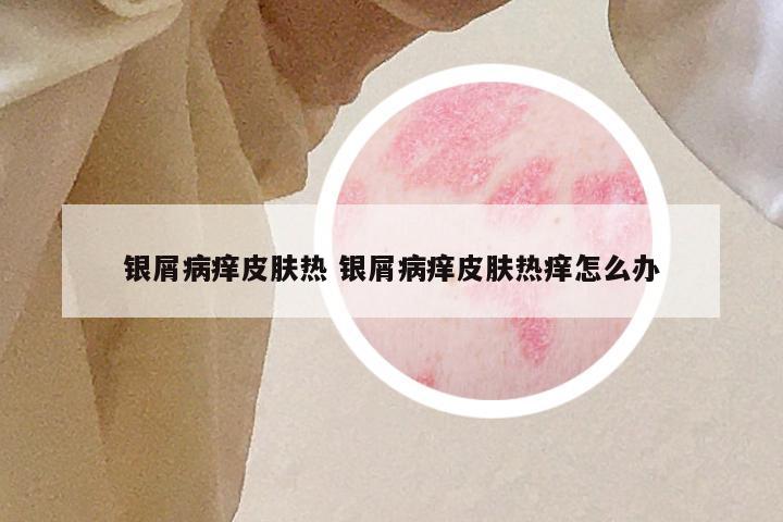 银屑病痒皮肤热 银屑病痒皮肤热痒怎么办