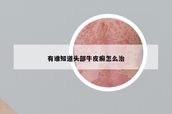 有谁知道头部牛皮癣怎么治