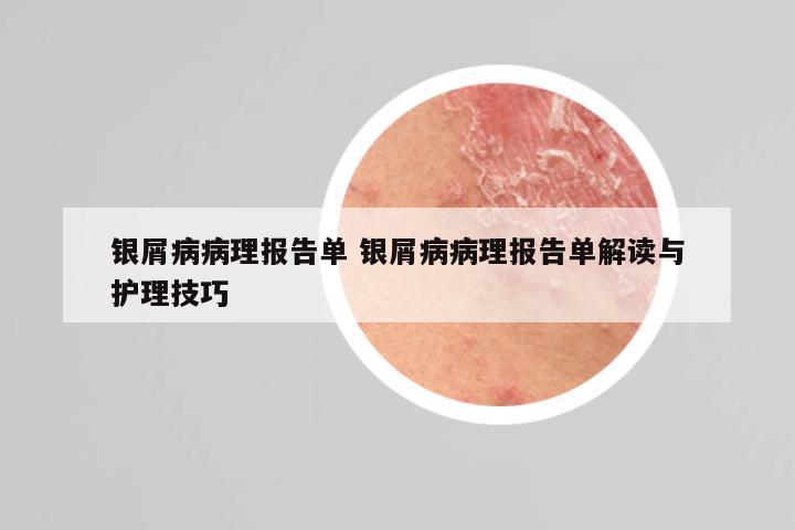 银屑病病理报告单 银屑病病理报告单解读与护理技巧