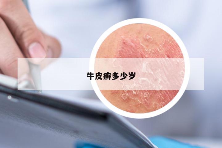 牛皮癣多少岁