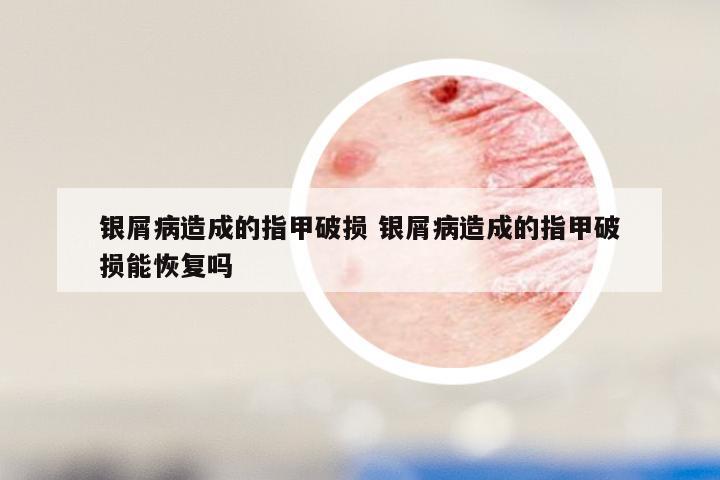 银屑病造成的指甲破损 银屑病造成的指甲破损能恢复吗