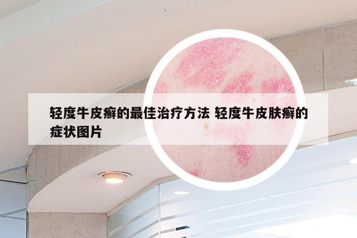 轻度牛皮癣的最佳治疗方法 轻度牛皮肤癣的症状图片