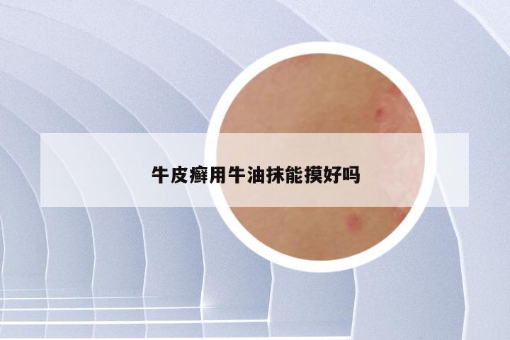 牛皮癣用牛油抹能摸好吗