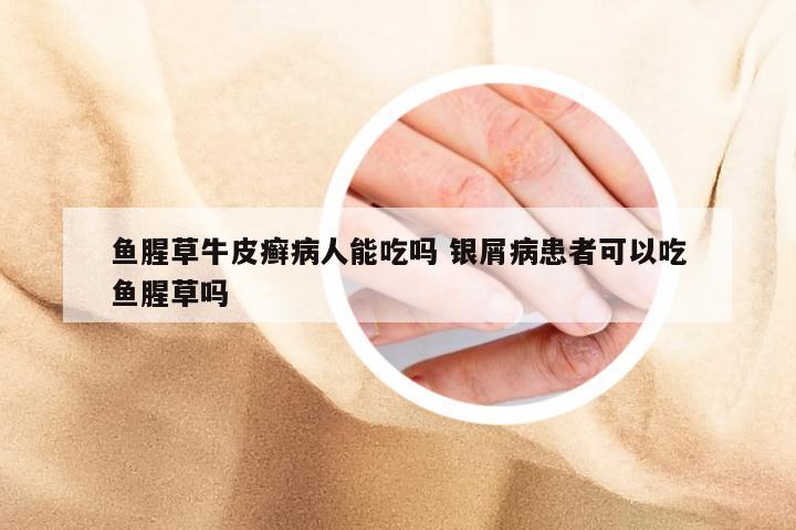 鱼腥草牛皮癣病人能吃吗 银屑病患者可以吃鱼腥草吗