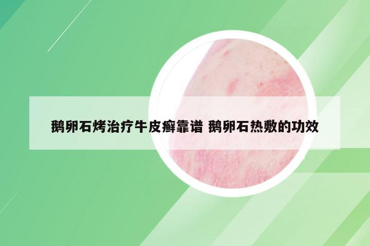 鹅卵石烤治疗牛皮癣靠谱 鹅卵石热敷的功效