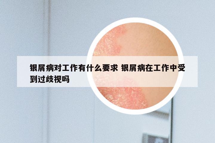 银屑病对工作有什么要求 银屑病在工作中受到过歧视吗