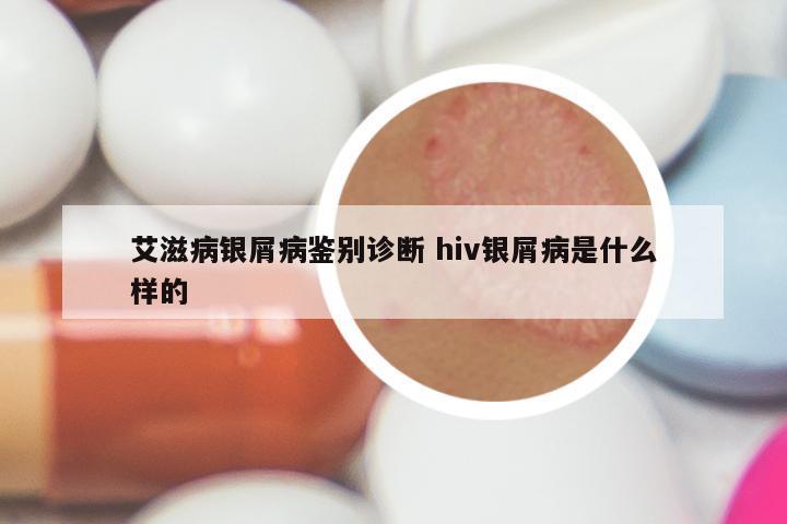 艾滋病银屑病鉴别诊断 hiv银屑病是什么样的