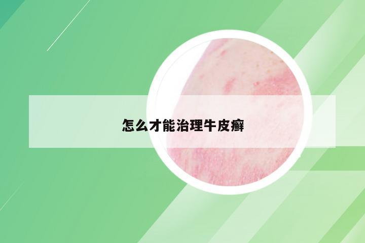 怎么才能治理牛皮癣