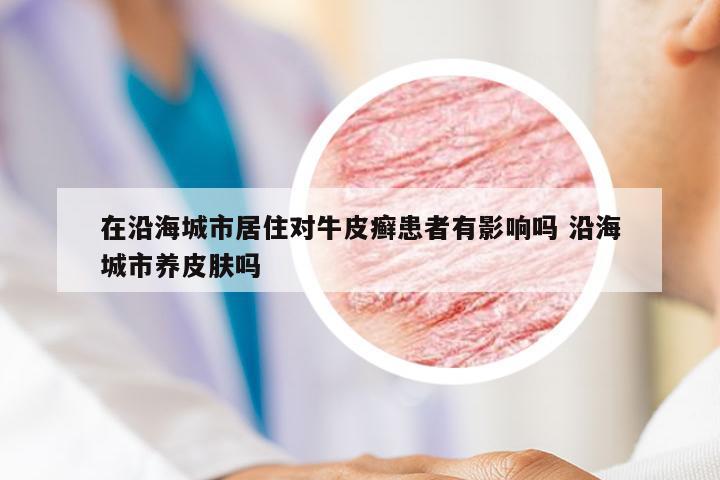 在沿海城市居住对牛皮癣患者有影响吗 沿海城市养皮肤吗