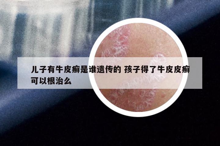 儿子有牛皮癣是谁遗传的 孩子得了牛皮皮癣可以根治么