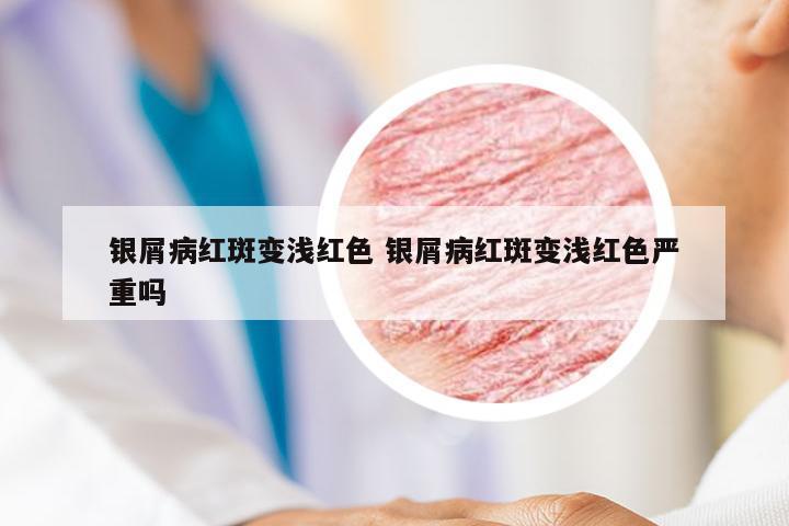 银屑病红斑变浅红色 银屑病红斑变浅红色严重吗
