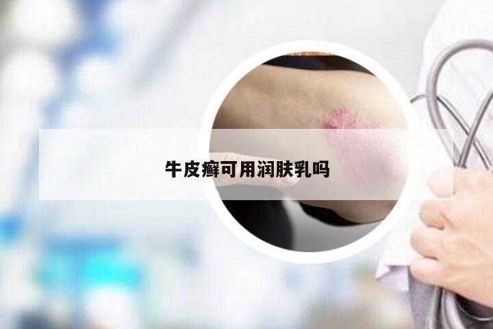 牛皮癣可用润肤乳吗