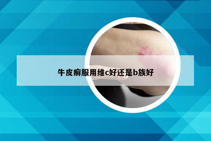 牛皮癣服用维c好还是b族好