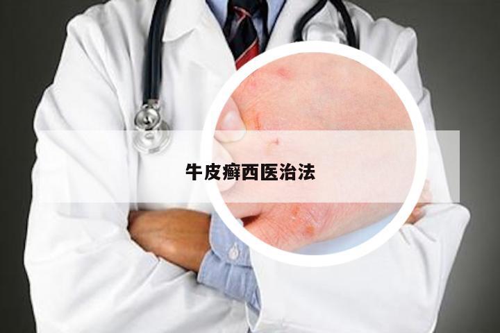 牛皮癣西医治法