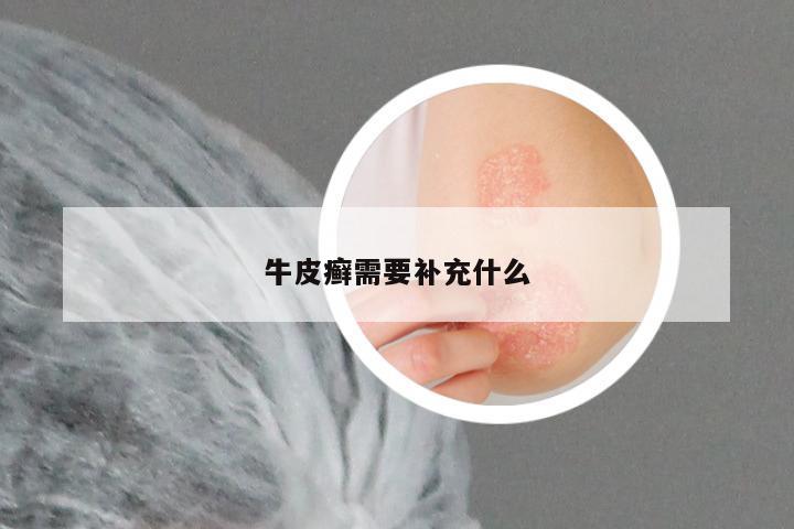 牛皮癣需要补充什么