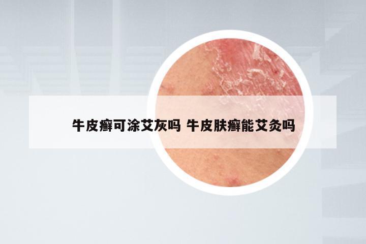 牛皮癣可涂艾灰吗 牛皮肤癣能艾灸吗