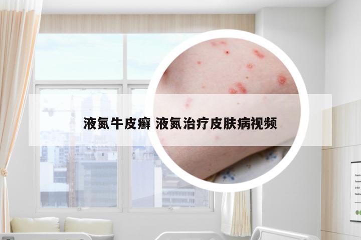 液氮牛皮癣 液氮治疗皮肤病视频