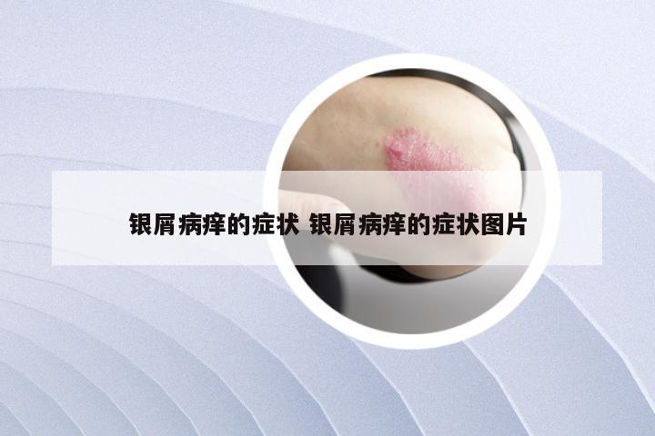 银屑病痒的症状 银屑病痒的症状图片