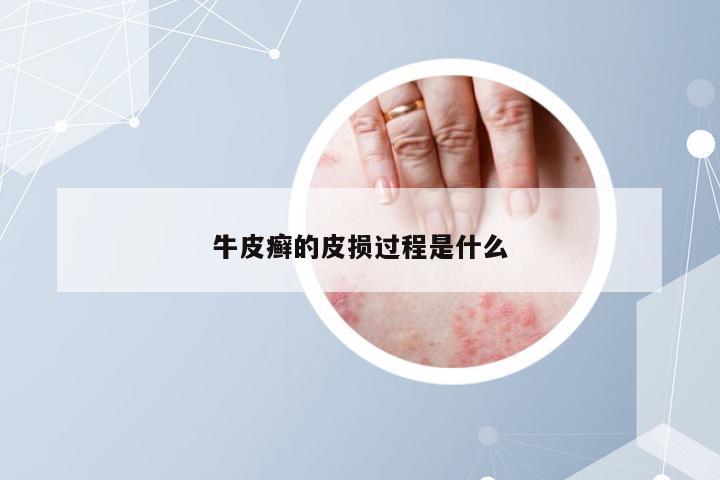牛皮癣的皮损过程是什么