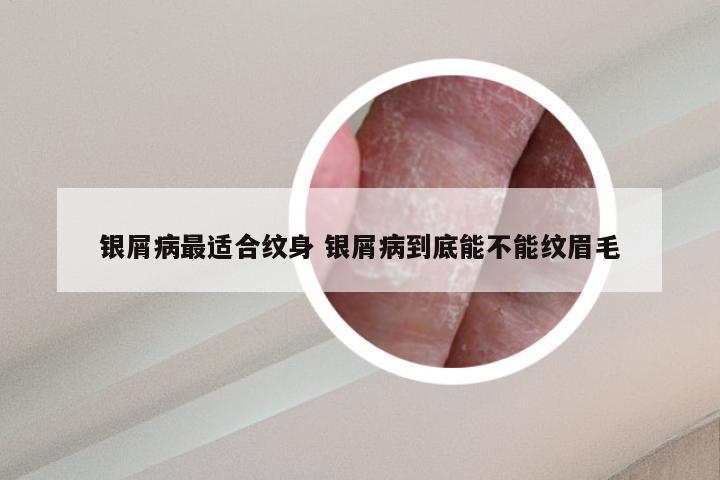 银屑病最适合纹身 银屑病到底能不能纹眉毛