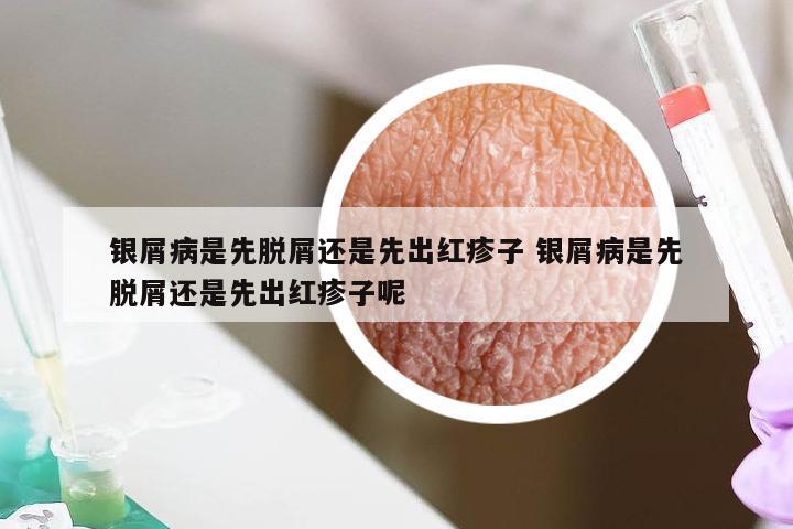 银屑病是先脱屑还是先出红疹子 银屑病是先脱屑还是先出红疹子呢