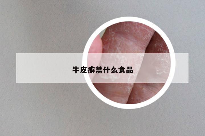 牛皮癣禁什么食品