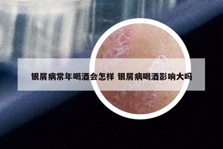 银屑病常年喝酒会怎样 银屑病喝酒影响大吗