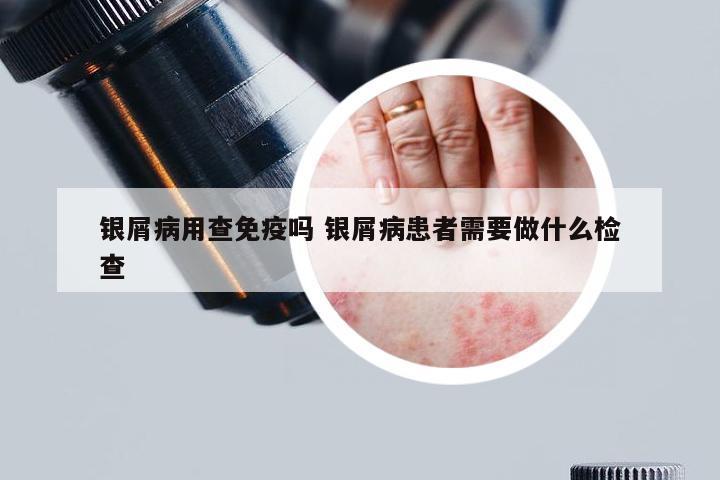 银屑病用查免疫吗 银屑病患者需要做什么检查