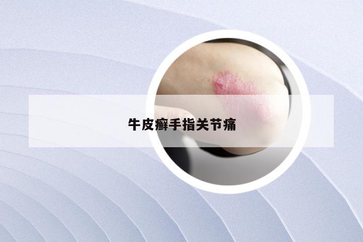 牛皮癣手指关节痛