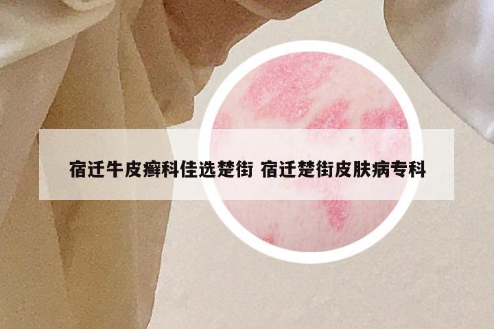 宿迁牛皮癣科佳选楚街 宿迁楚街皮肤病专科