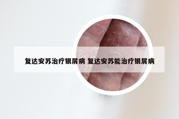 复达安苏治疗银屑病 复达安苏能治疗银屑病