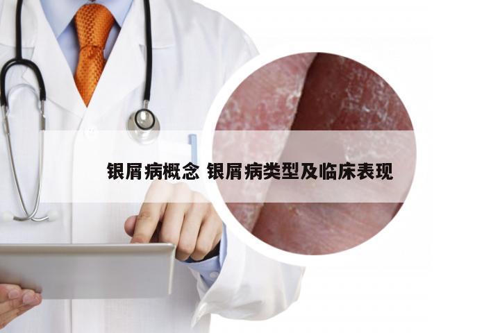银屑病概念 银屑病类型及临床表现