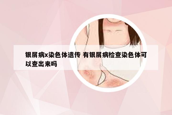 银屑病x染色体遗传 有银屑病检查染色体可以查出来吗