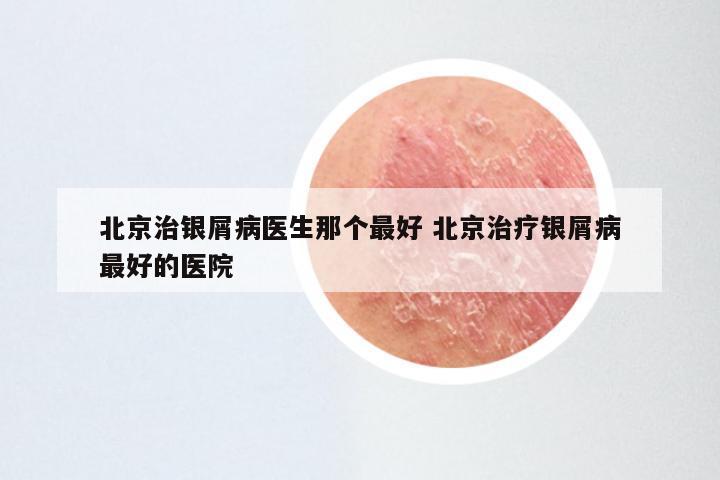 北京治银屑病医生那个最好 北京治疗银屑病最好的医院