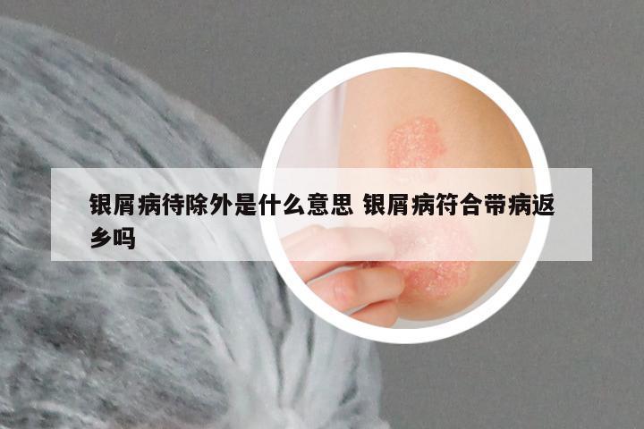 银屑病待除外是什么意思 银屑病符合带病返乡吗
