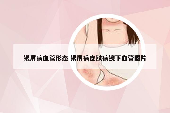 银屑病血管形态 银屑病皮肤病镜下血管图片