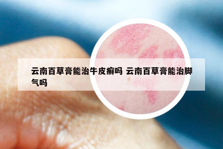 云南百草膏能治牛皮癣吗 云南百草膏能治脚气吗