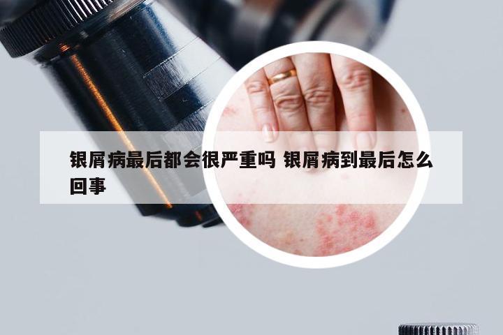 银屑病最后都会很严重吗 银屑病到最后怎么回事