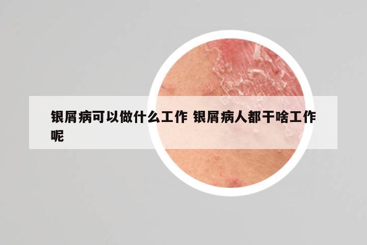 银屑病可以做什么工作 银屑病人都干啥工作呢