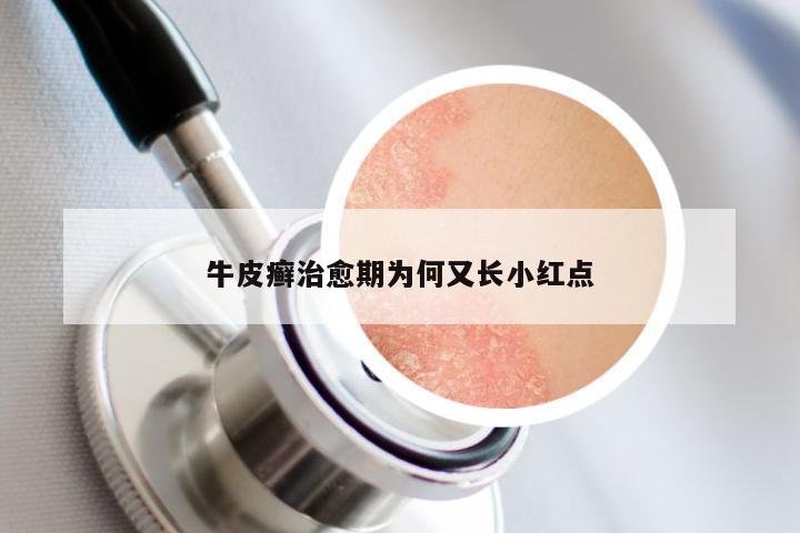 牛皮癣治愈期为何又长小红点
