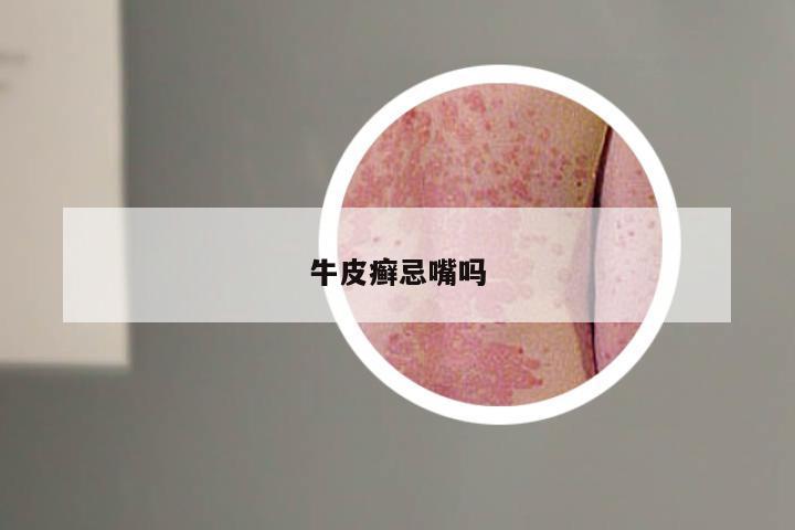 牛皮癣忌嘴吗