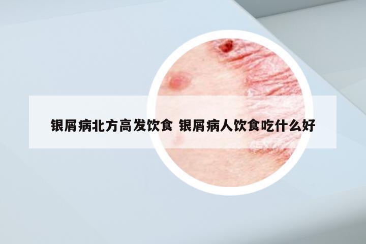 银屑病北方高发饮食 银屑病人饮食吃什么好