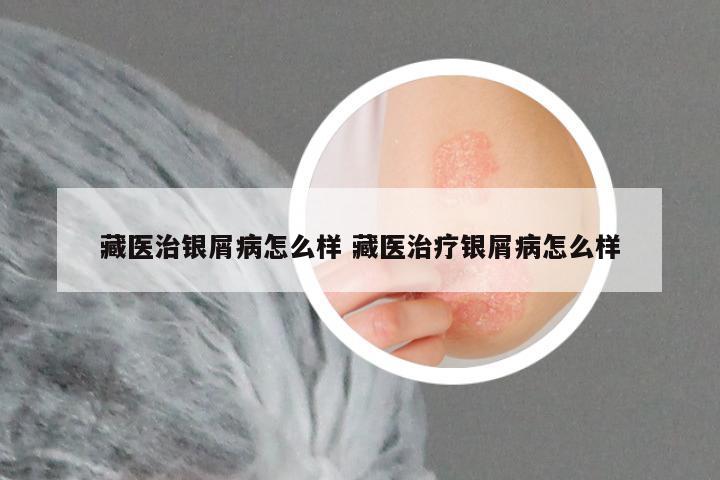 藏医治银屑病怎么样 藏医治疗银屑病怎么样