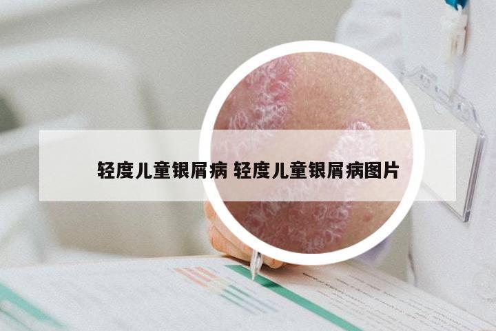 轻度儿童银屑病 轻度儿童银屑病图片