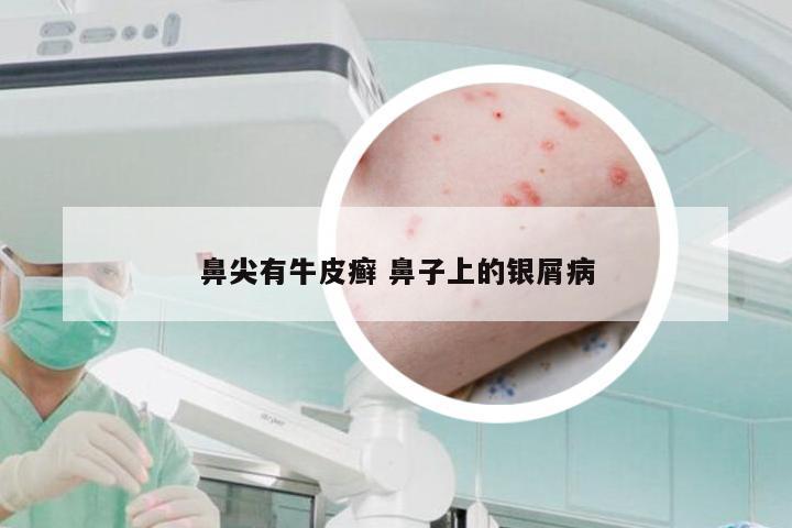 鼻尖有牛皮癣 鼻子上的银屑病