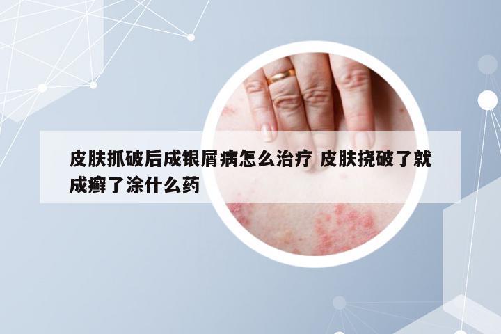 皮肤抓破后成银屑病怎么治疗 皮肤挠破了就成癣了涂什么药