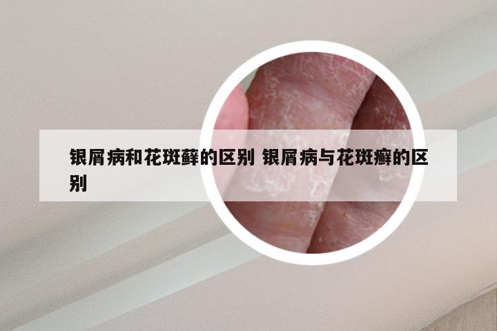 银屑病和花斑藓的区别 银屑病与花斑癣的区别
