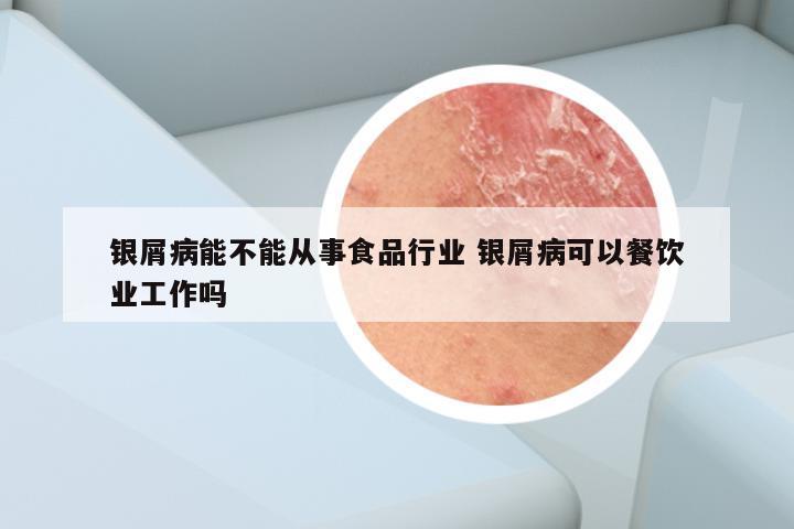 银屑病能不能从事食品行业 银屑病可以餐饮业工作吗