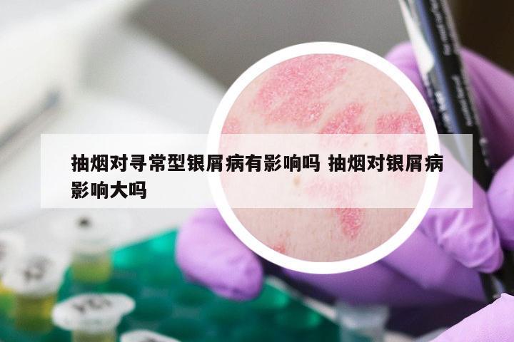 抽烟对寻常型银屑病有影响吗 抽烟对银屑病影响大吗